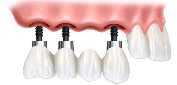 Dental implants in Bokanova Clinic, Mexico