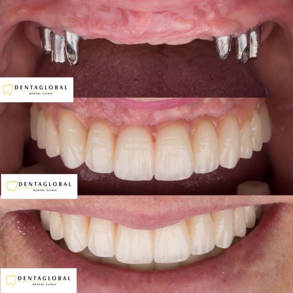 Dental prosthesis at Dentaglobal