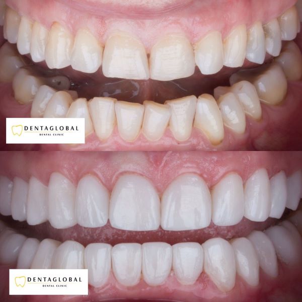 Veneers installation at Dentaglobal