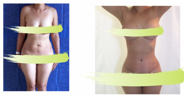 Liposuction, tummy tuck, breast augmentation at Salutaris