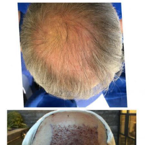 Before and after hair transplant: a real patient's photo