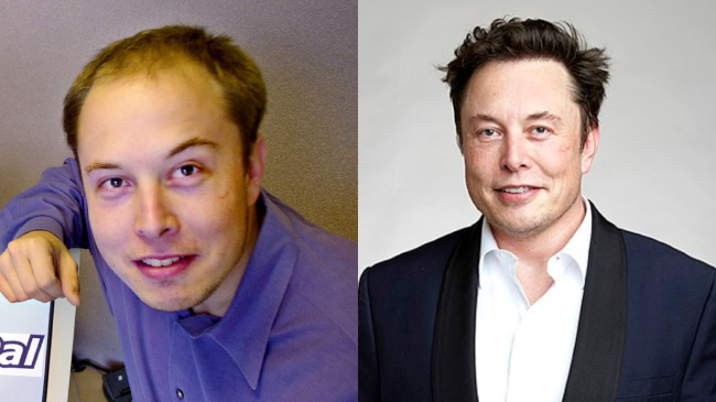 Photo of Elon Musk before and after hair transplant