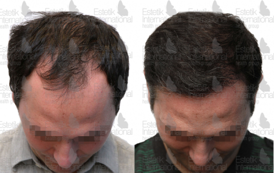 Before and after hair transplant photos