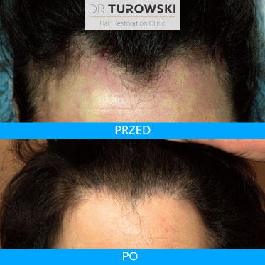 Female before and after hair transplant