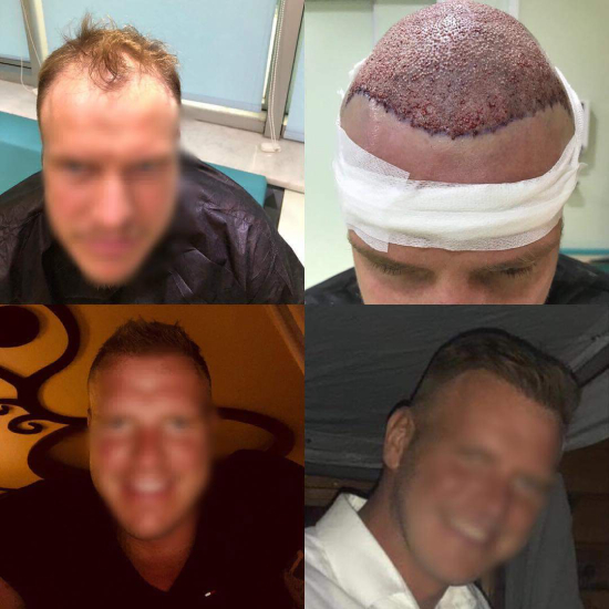 Hair transplant result