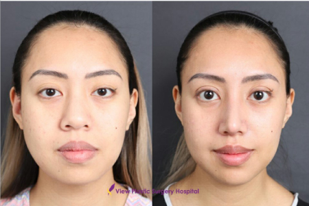 Фото до и после ринопластики в клинике View Plastic Surgery (Южная Корея) Фото до и после ринопластики в клинике View Plastic Surgery (Южная Корея)