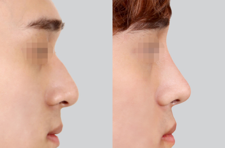 Фото до и после ринопластики в клинике View Plastic Surgery (Южная Корея) Фото до и после ринопластики в клинике View Plastic Surgery (Южная Корея)
