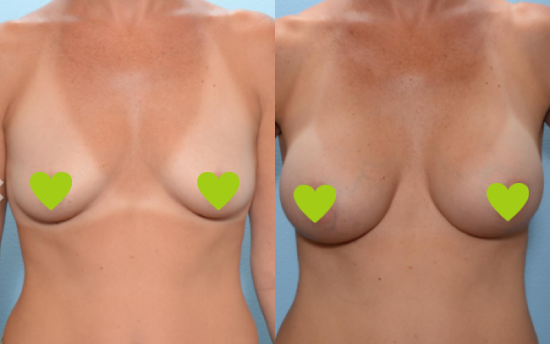 Breasts before and after Mentor implants installation