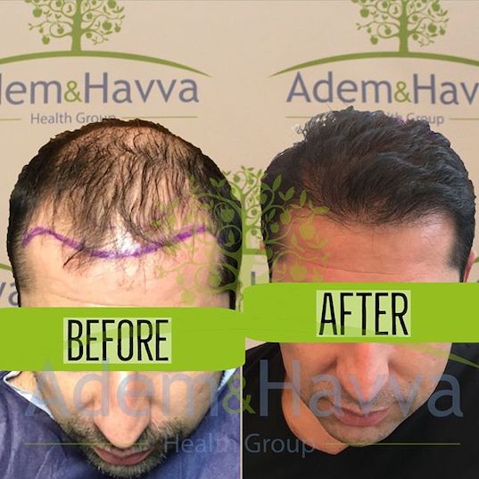 Hair Transplant Prices In Turkey Packages From 1 350
