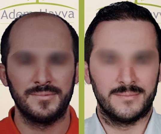 Hair Transplant Prices In Turkey Packages From 1 350