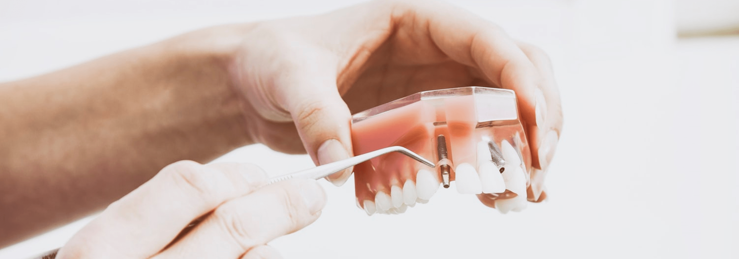 Los implantes dentales más baratos del mundo.