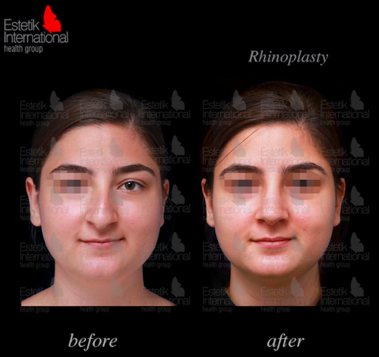 Before and after photos of a nose job at Estetik International