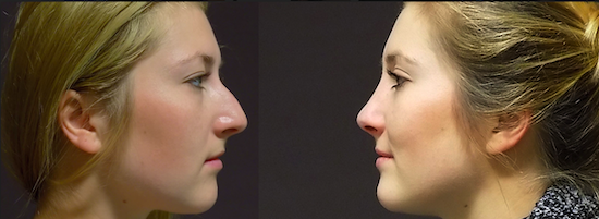 Before and after photos of a nose job at FORME