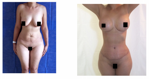 Body contouring results